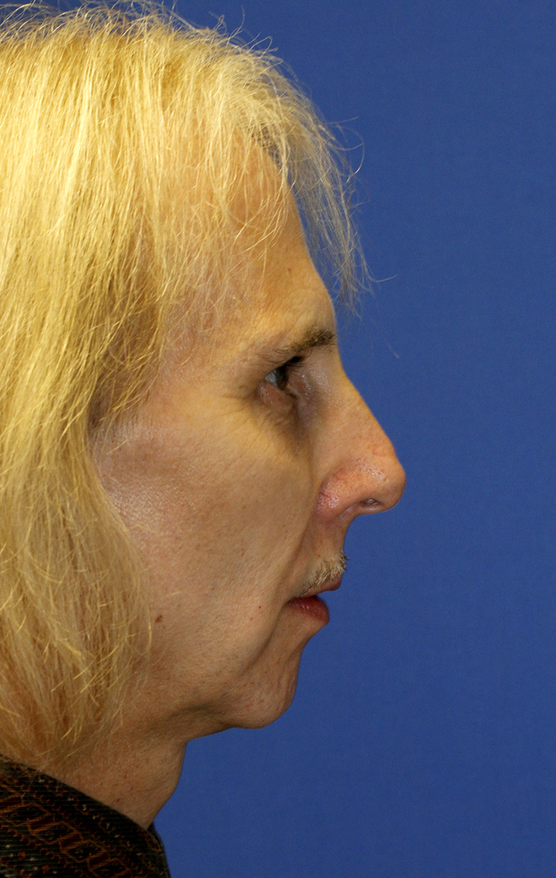 Feminization Rhinoplasty Before R Profile