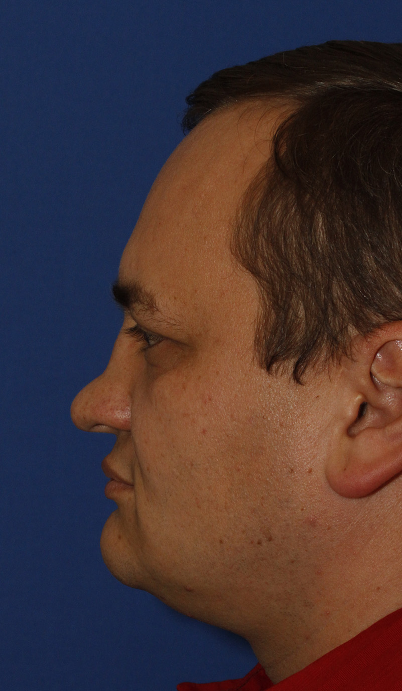 Rhinoplasty Before L Profile