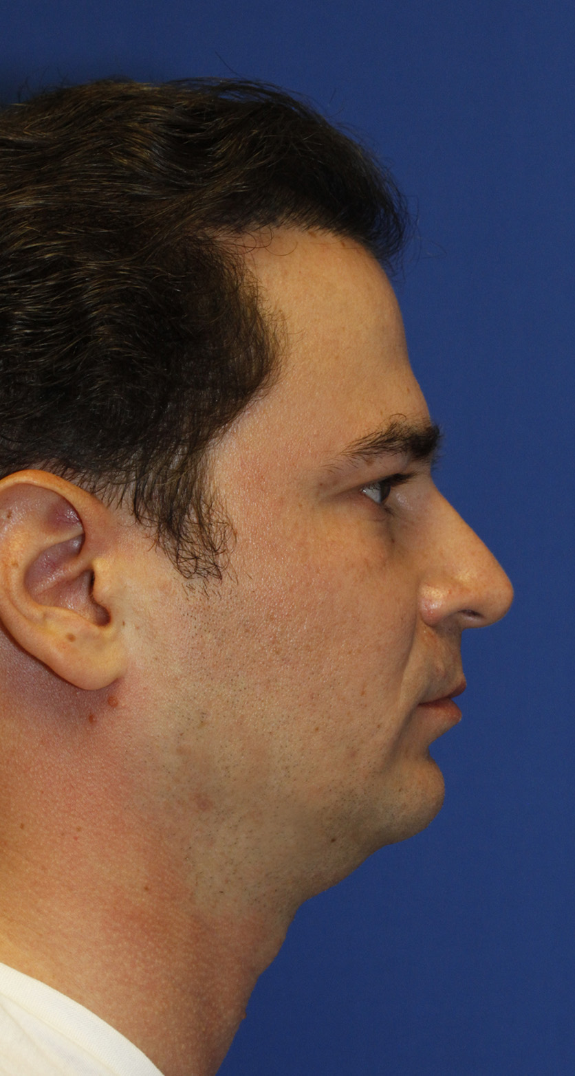 Rhinoplasty Before R Profile