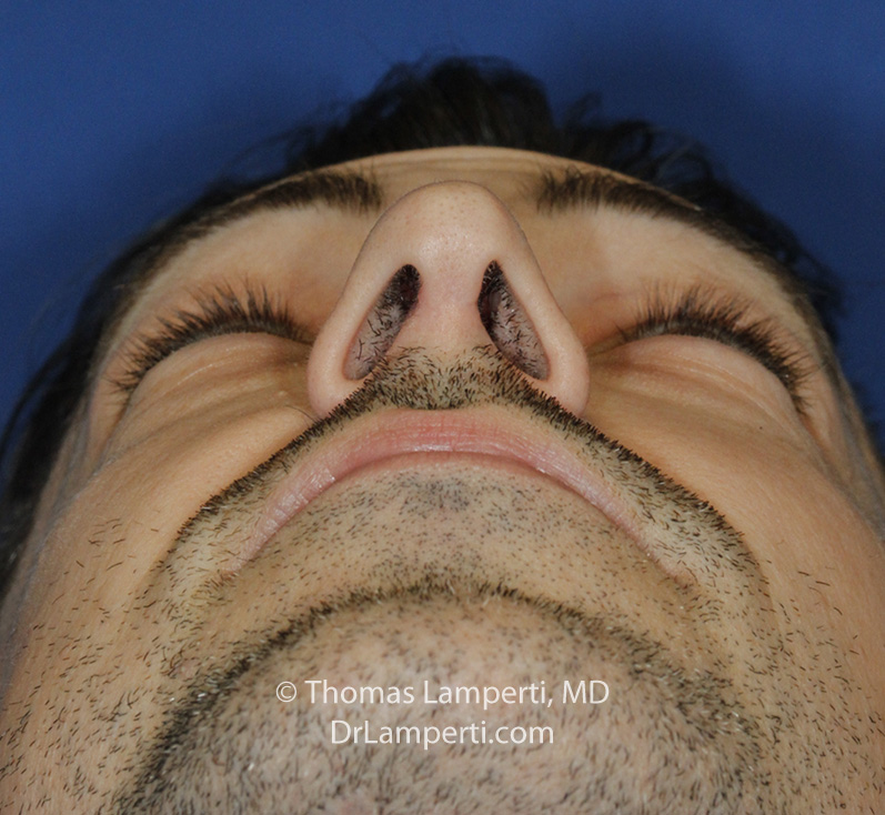 After Rhinoplasty Base