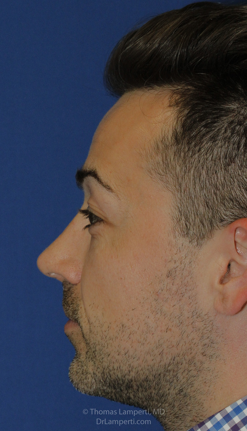 After Rhinoplasty L Profile