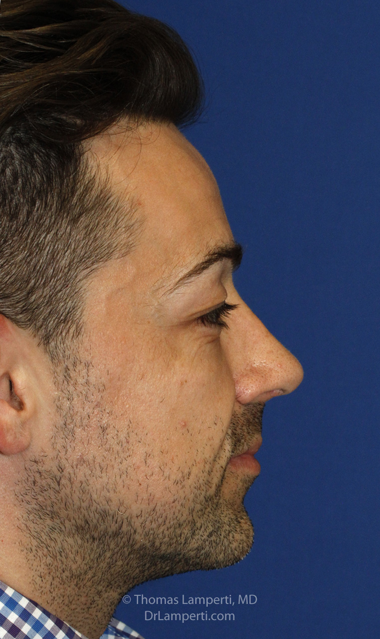 After Rhinoplasty R Profile