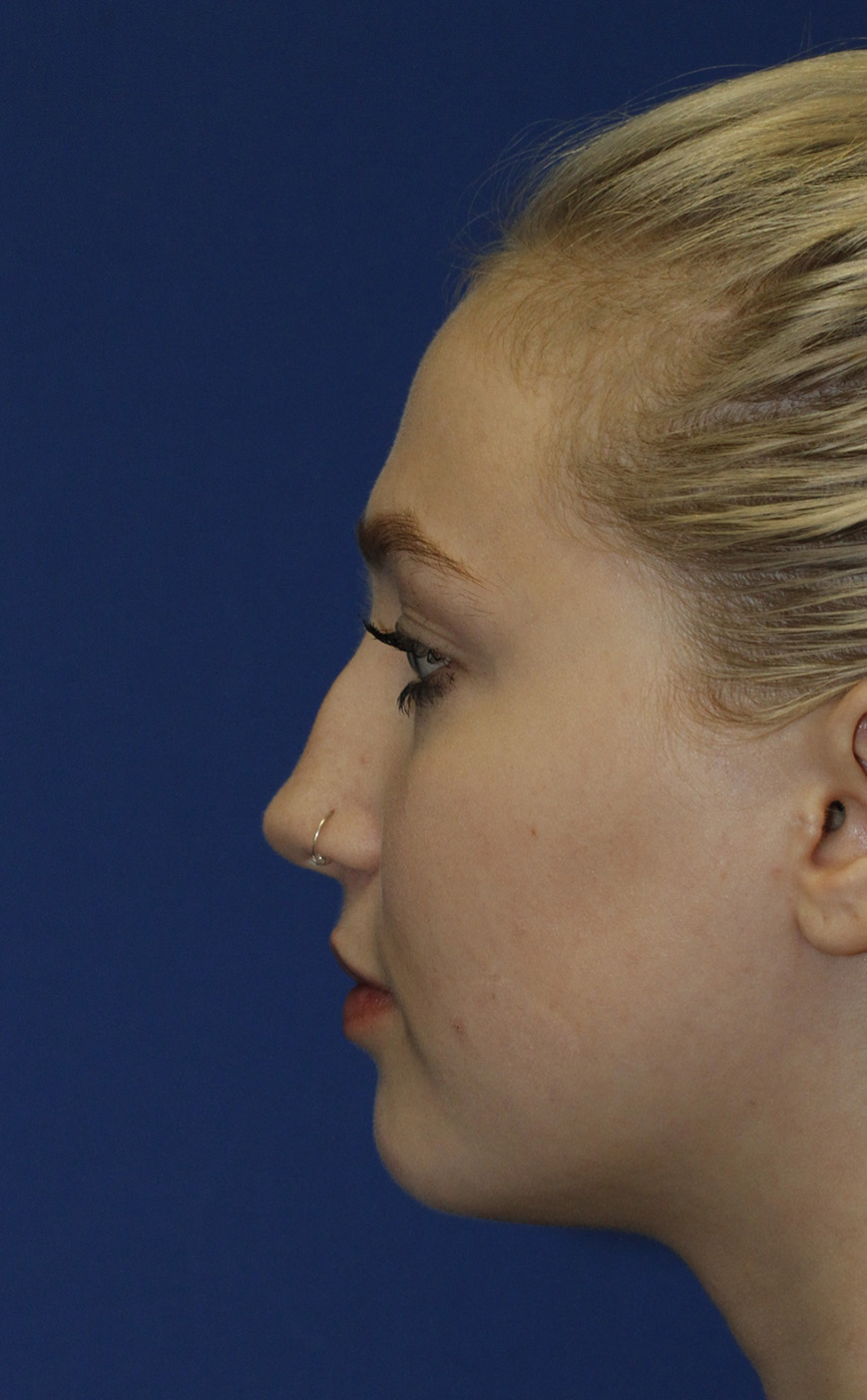 Rhinoplasty Before L Profile