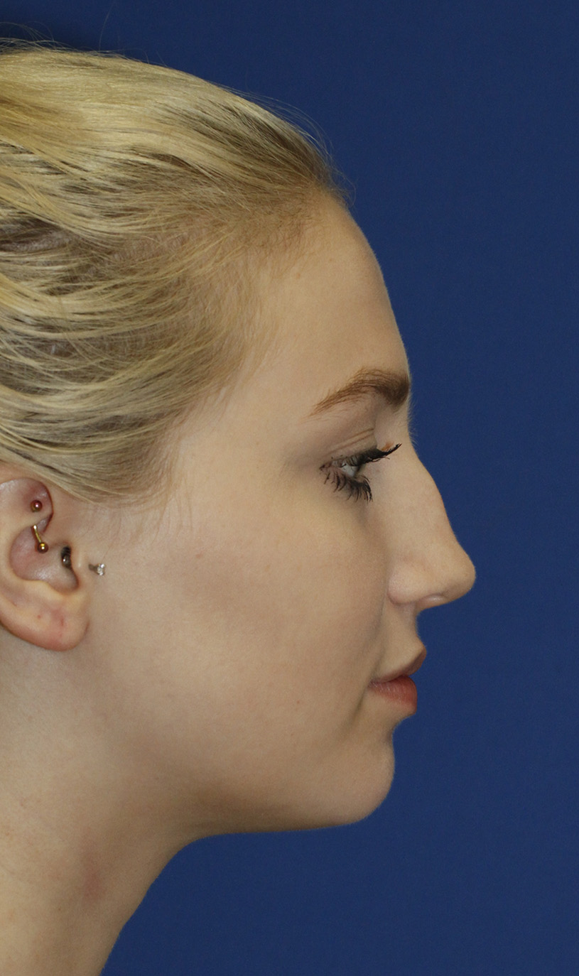 Rhinoplasty Before R Profile