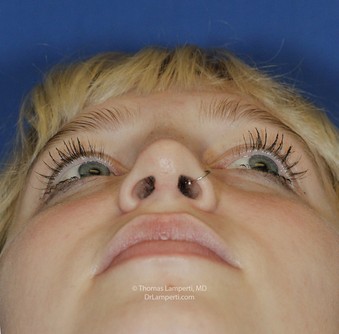 Rhinoplasty After Base