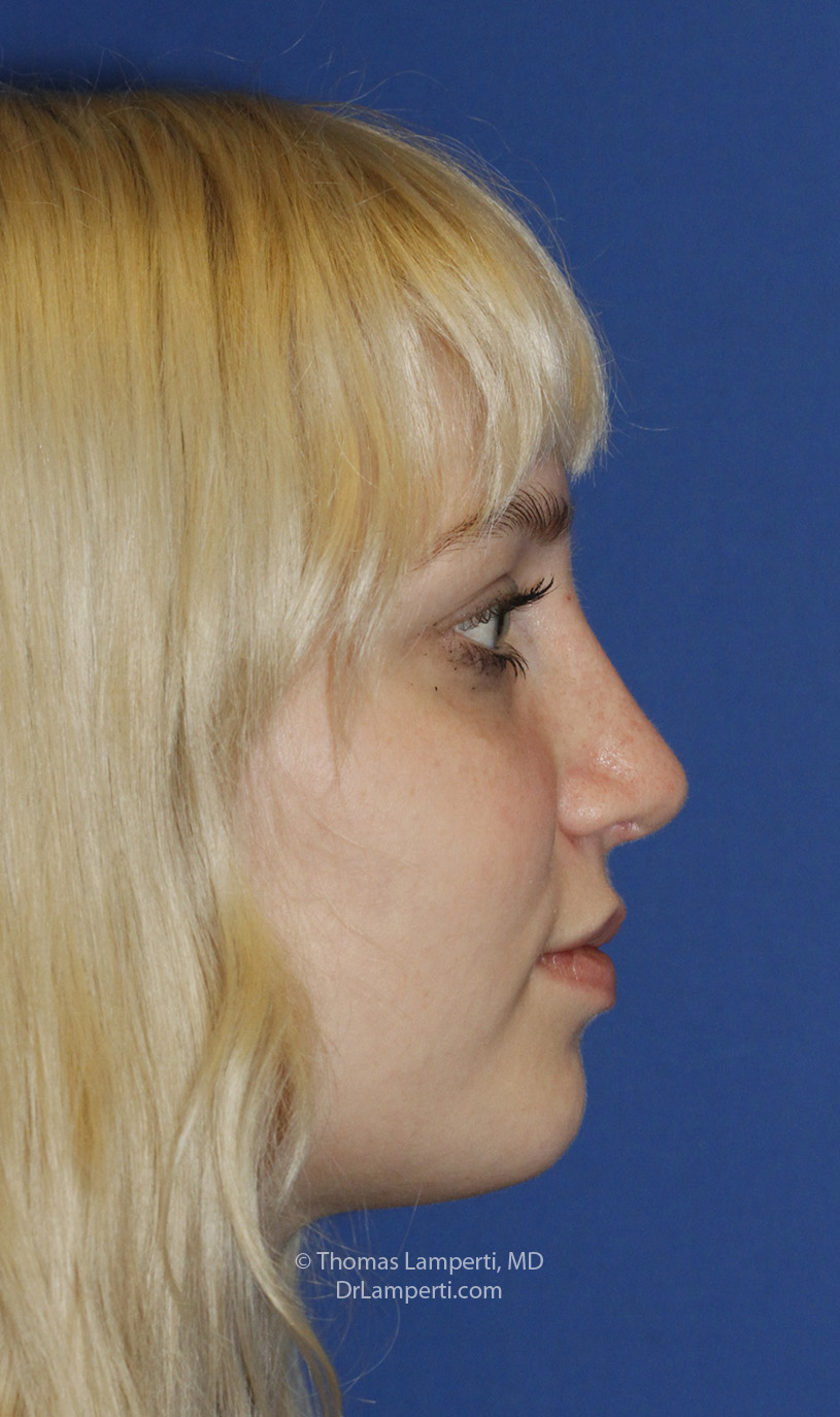 Rhinoplasty After R Profile