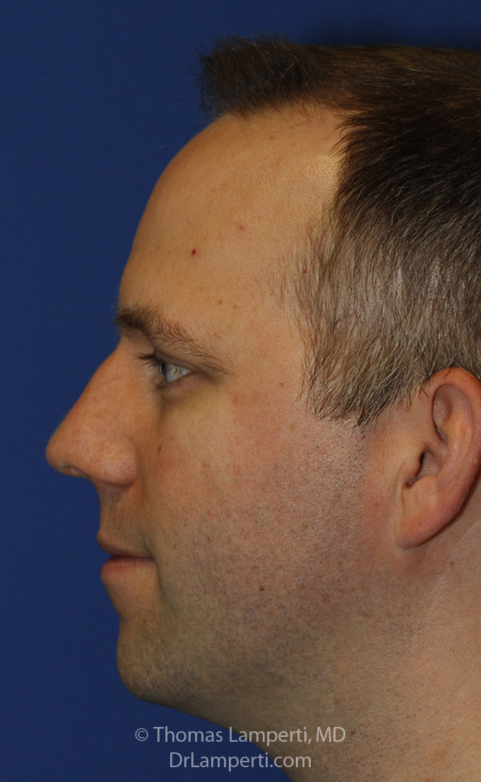 Rhinoplasty After L Profile