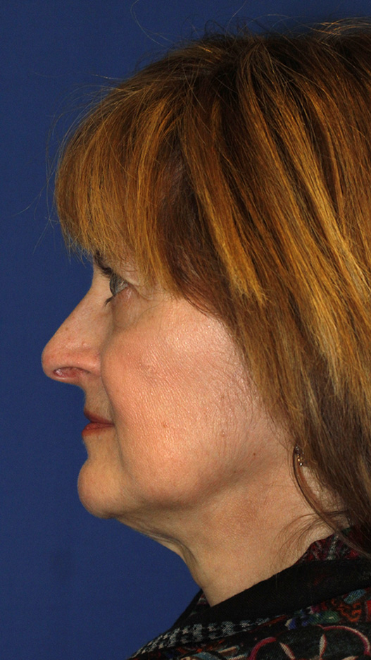 Rhinoplasty Before L Profile