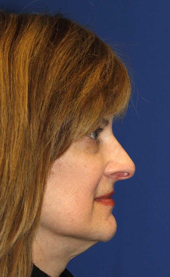 Rhinoplasty Before R Profile