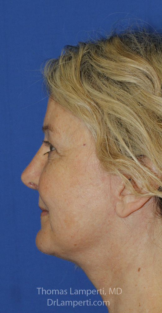 Rhinoplasty After L Profile