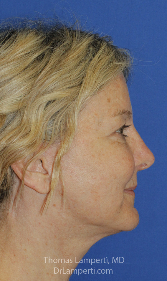 Rhinoplasty After R Profile