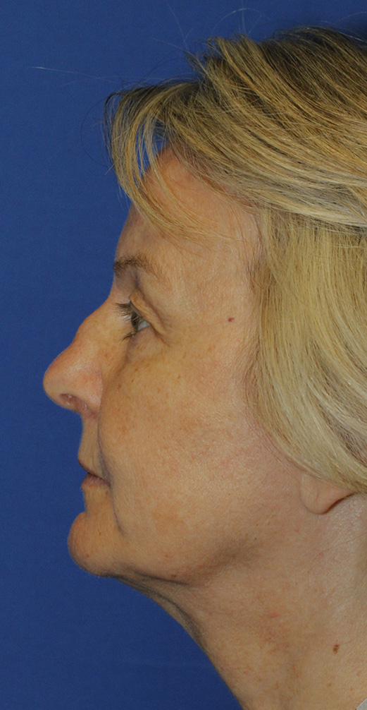 Rhinoplasty Before L Profile