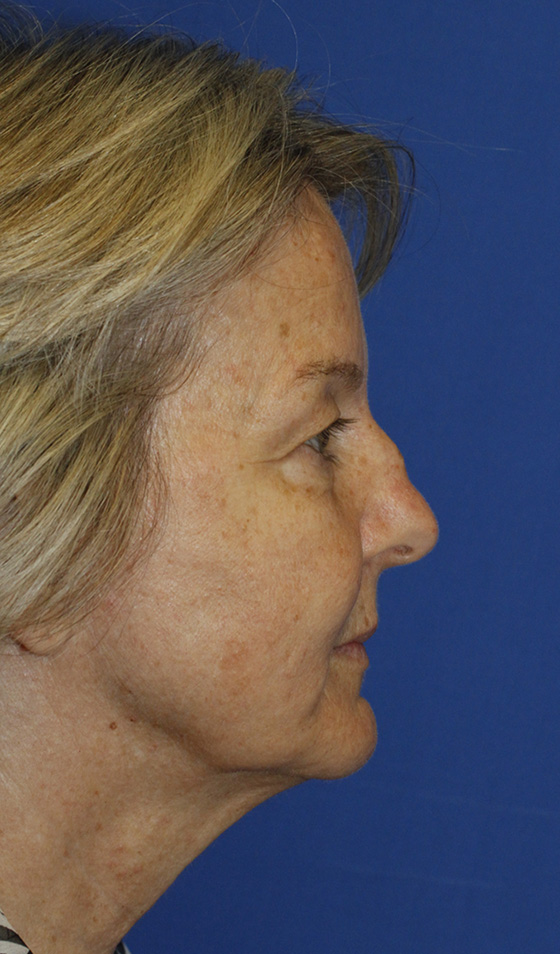 Rhinoplasty Before R Profile