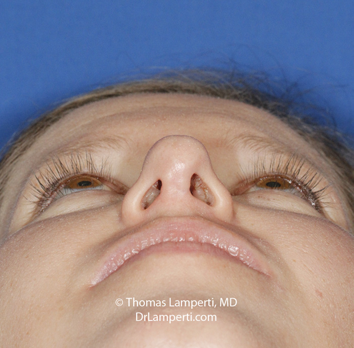 Rhinoplasty Base After