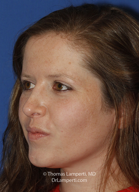 Rhinoplasty L Oblique After