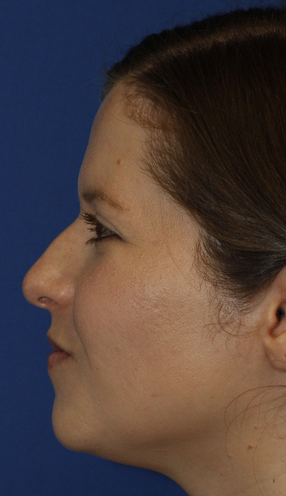 Rhinoplasty L Profile Before