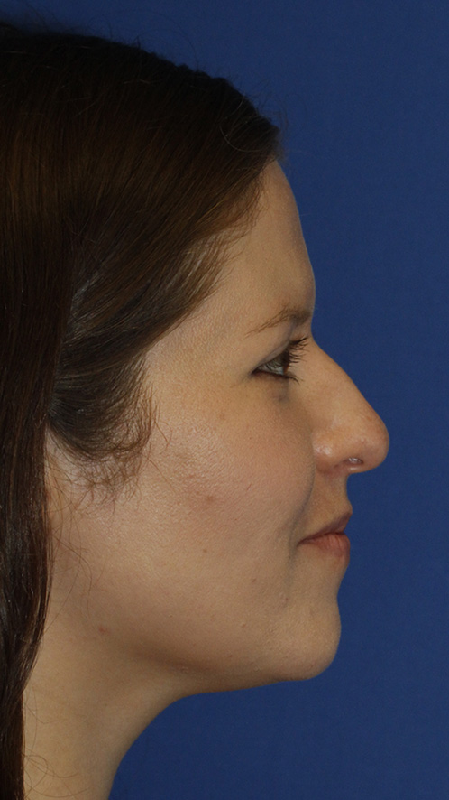 Rhinoplasty R Profile Before