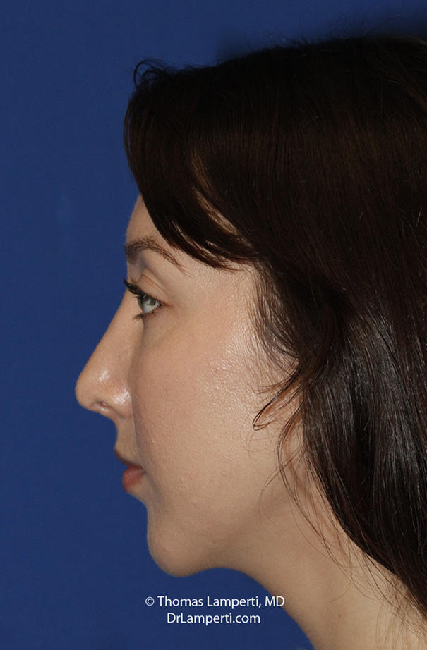 Rhinoplasty After L Profile