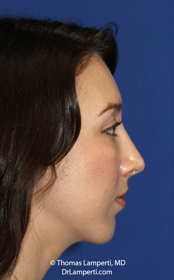 Rhinoplasty After R Profile