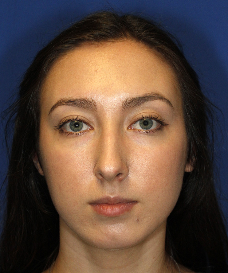 Rhinoplasty Before Frontal