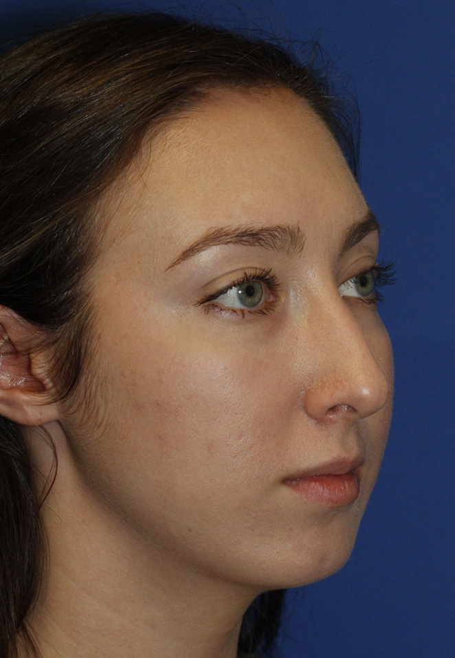 Rhinoplasty Before R Oblique