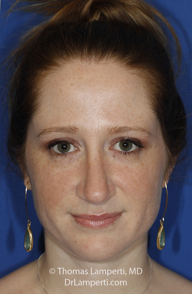 Rhinoplasty After Frontal