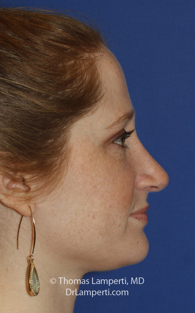 Rhinoplasty After R Profile