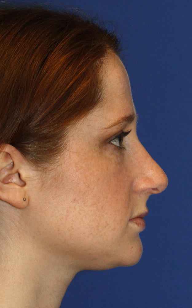 Rhinoplasty Before R Profile