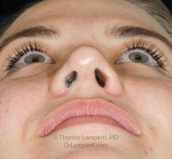 Rhinoplasty After Base