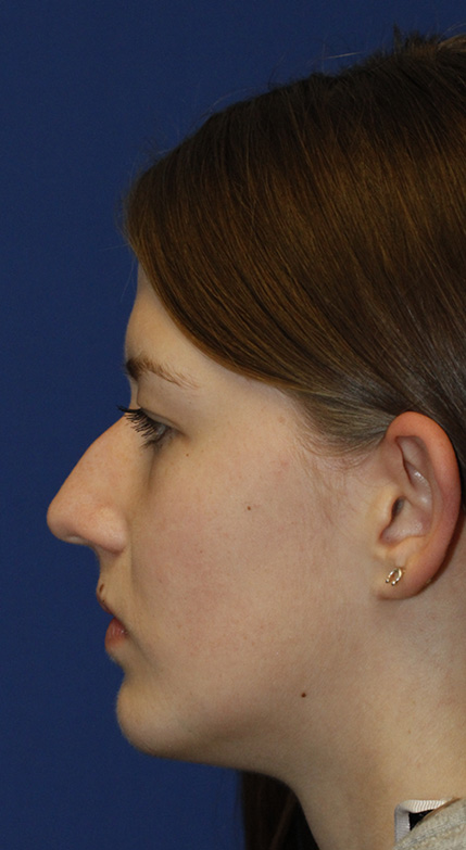 Rhinoplasty Before L Profile