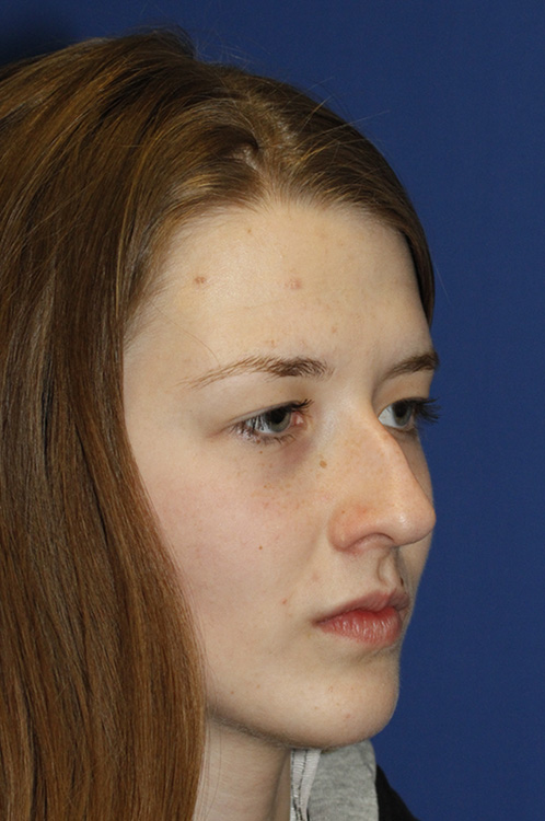 Rhinoplasty Before R Oblique