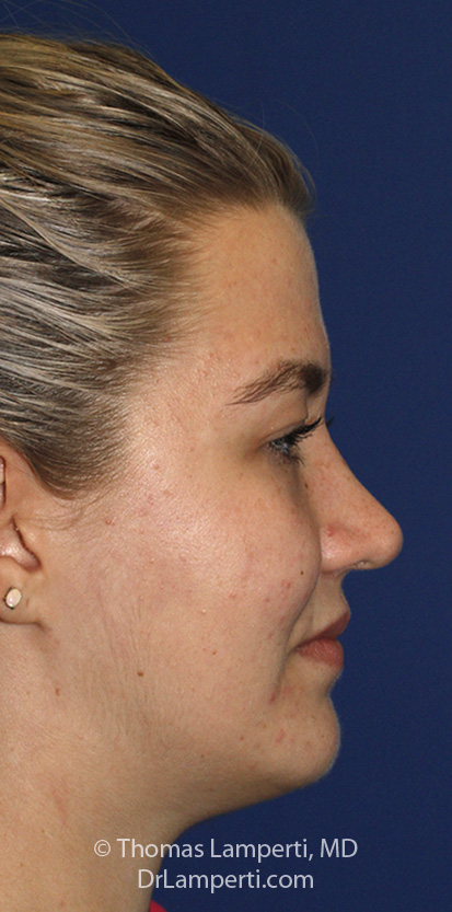 Rhinoplasty After R Profile