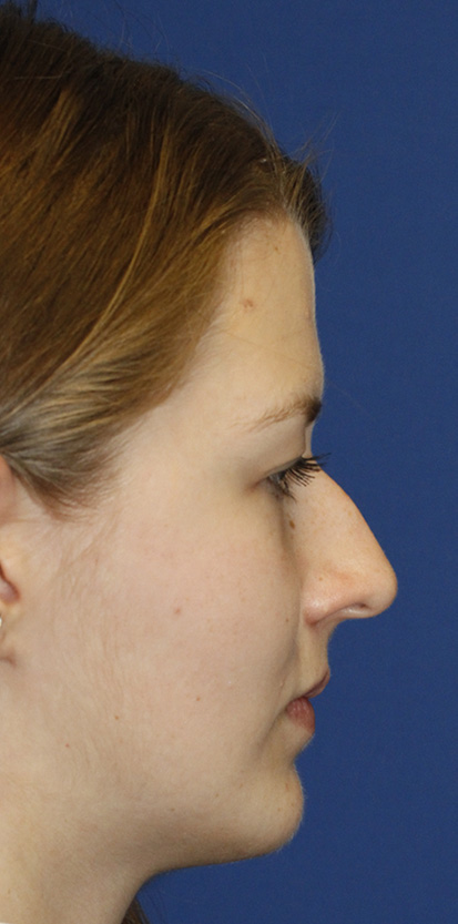 Rhinoplasty Before R Profile