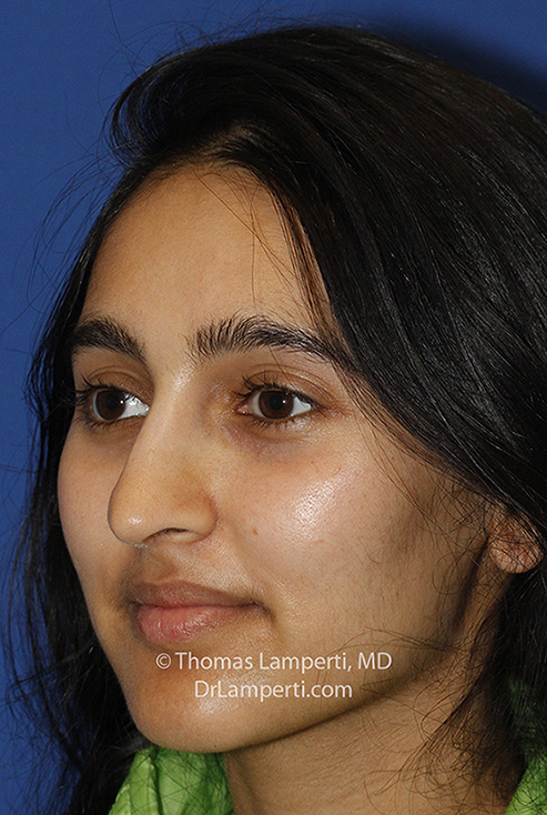 Rhinoplasty After L Oblique