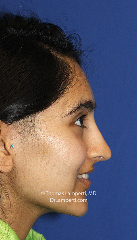 Rhinoplasty After R Profile