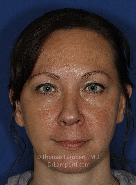 Rhinoplasty After Frontal