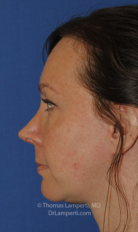 Rhinoplasty After L Profile