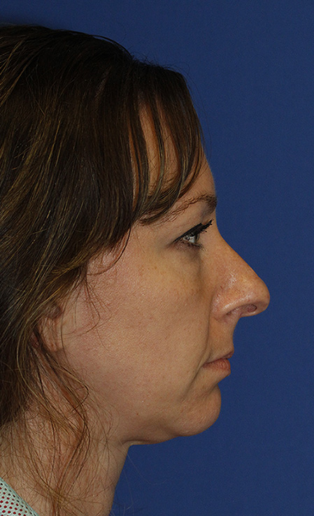 Rhinoplasty Before R Profile