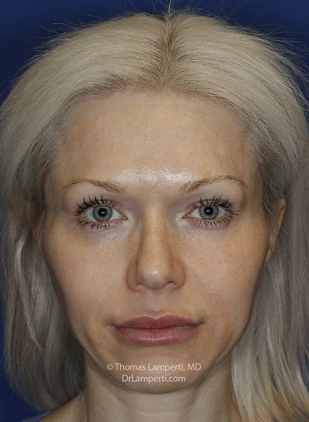 Rhinoplasty After Frontal