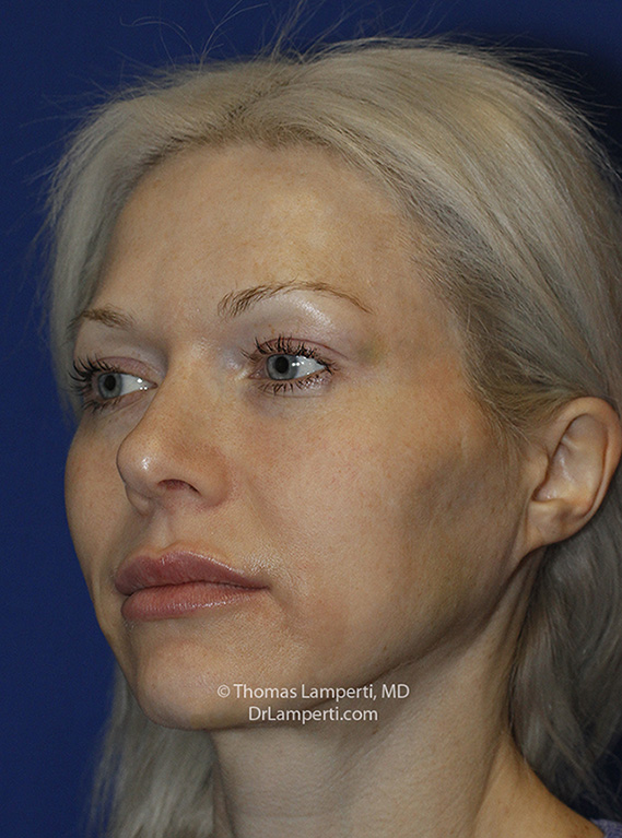 Rhinoplasty After L Oblique