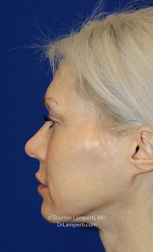 Rhinoplasty After L Profile