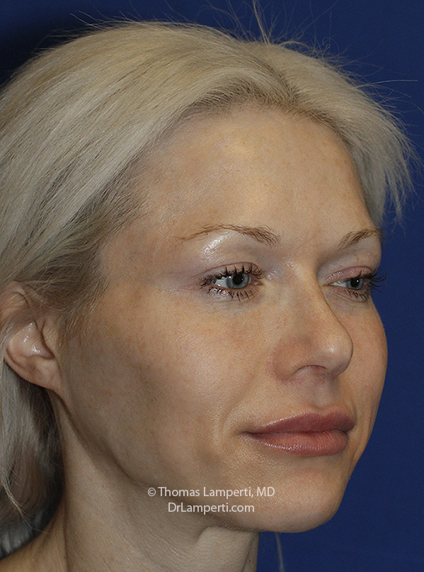 Rhinoplasty After R Oblique