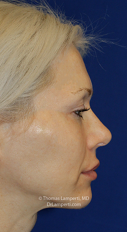 Rhinoplasty After R Profile