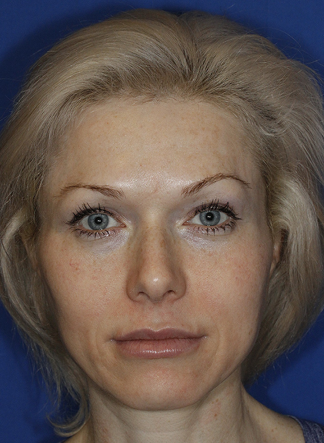 Rhinoplasty Before Frontal