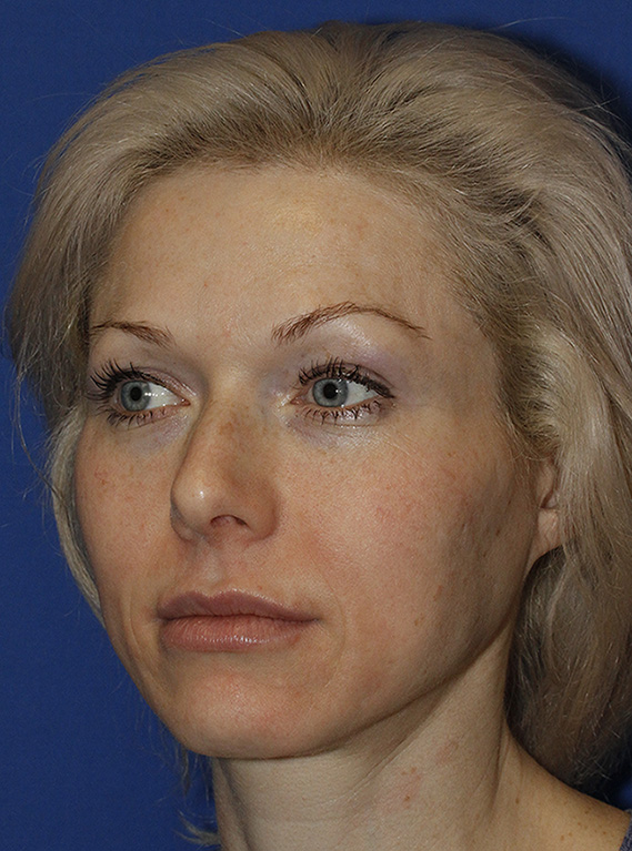 Rhinoplasty Before L Oblique