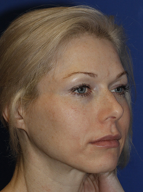 Rhinoplasty Before R Oblique