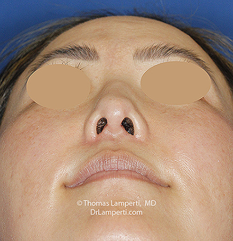 Rhinoplasty After Base