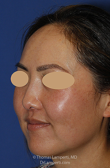 Rhinoplasty After L Oblique