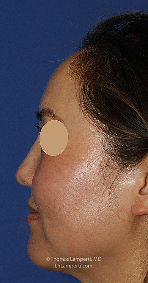 Rhinoplasty After L Profile