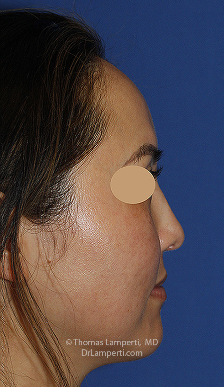 Rhinoplasty After R Profile